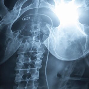X-ray examination revealing a retained kidney stent in a patient who suffered abdominal pain for nearly two years after surgery