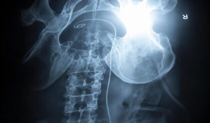 X-ray examination revealing a retained kidney stent in a patient who suffered abdominal pain for nearly two years after surgery
